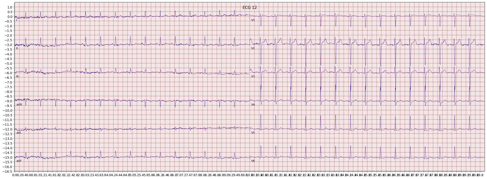 ECG example image