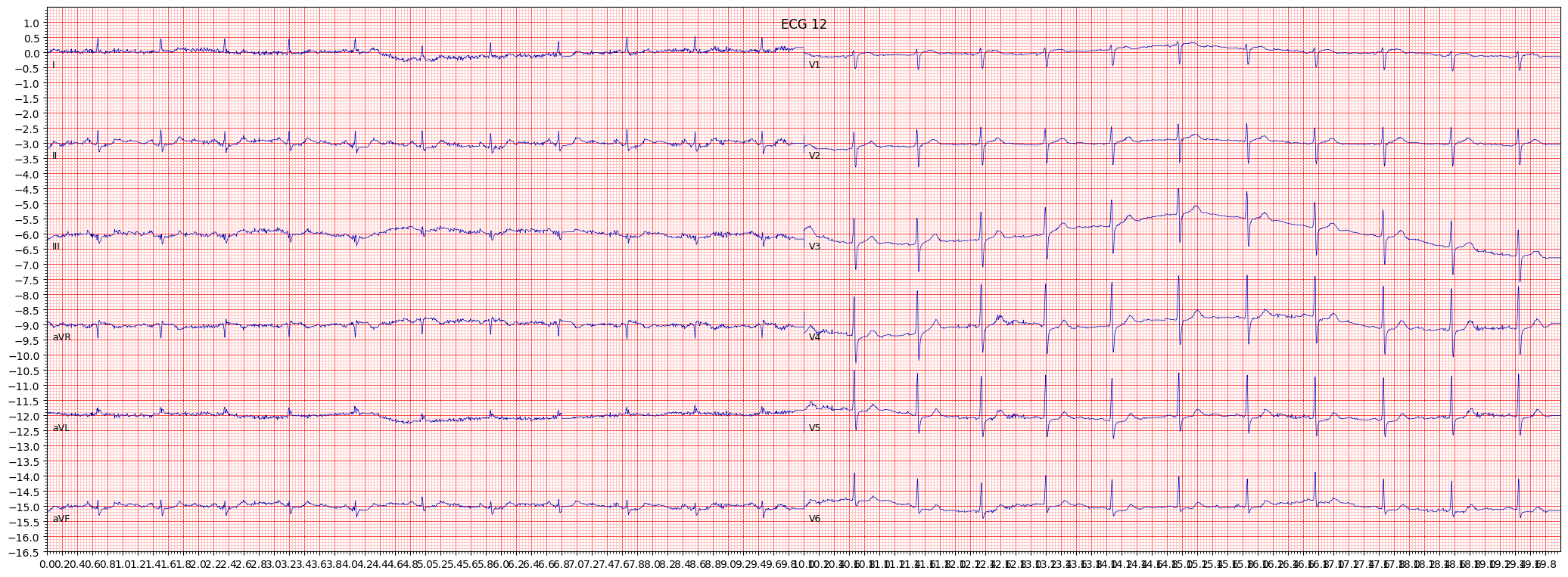 ECG example image