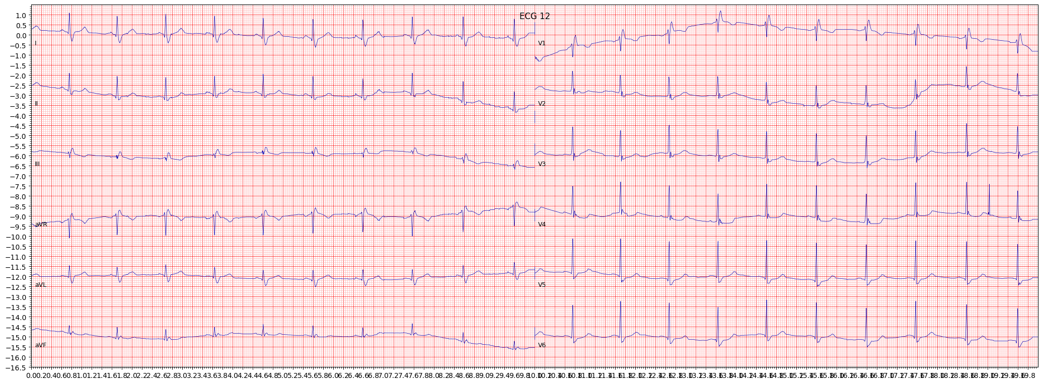 ECG example image