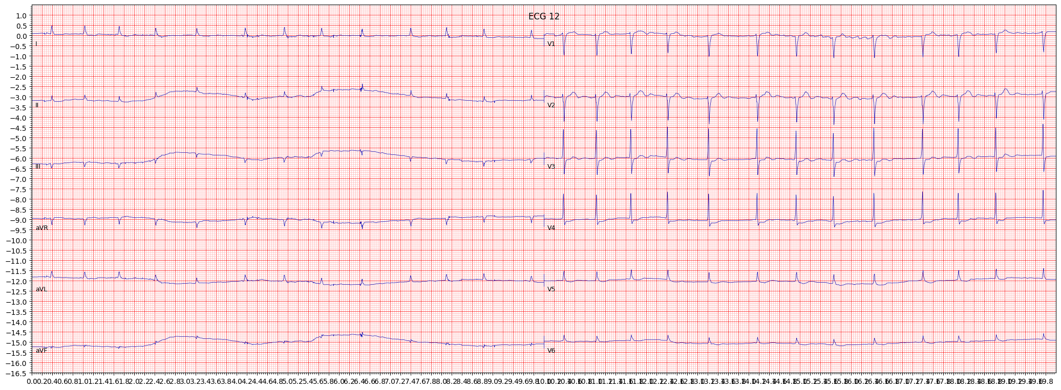 inferolateral myocardial infarction (ILMI) example 4203