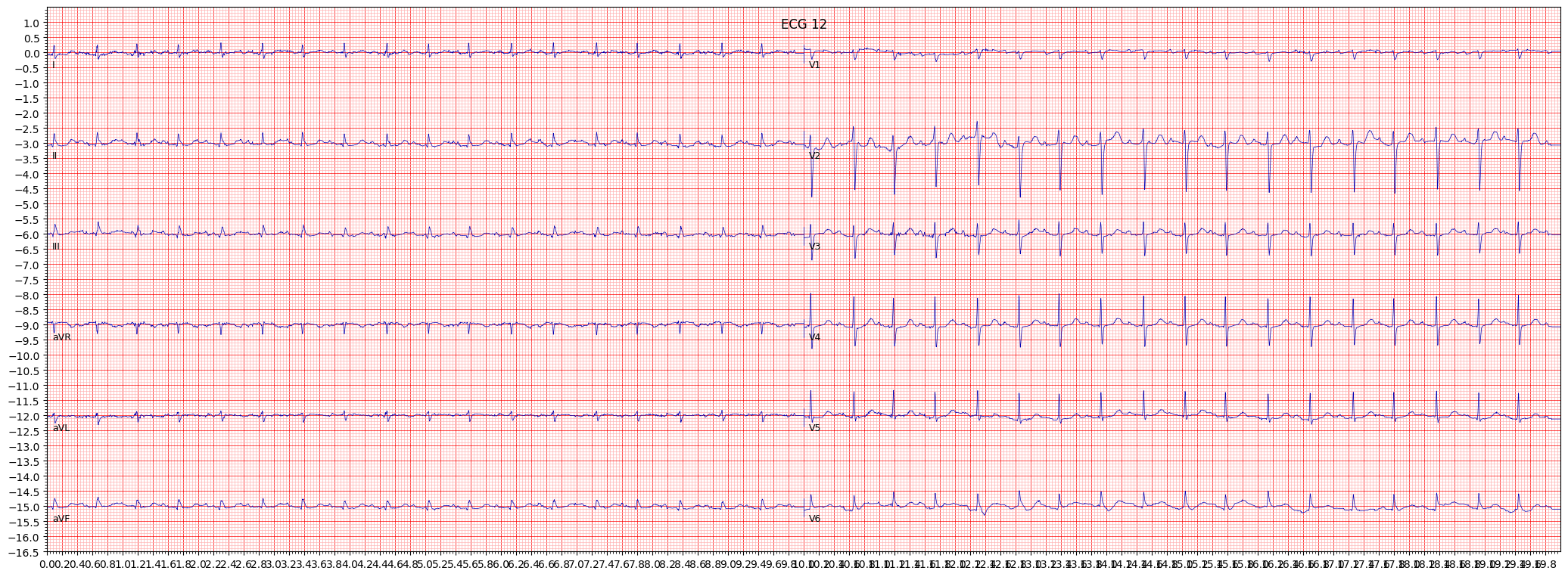 ECG example image