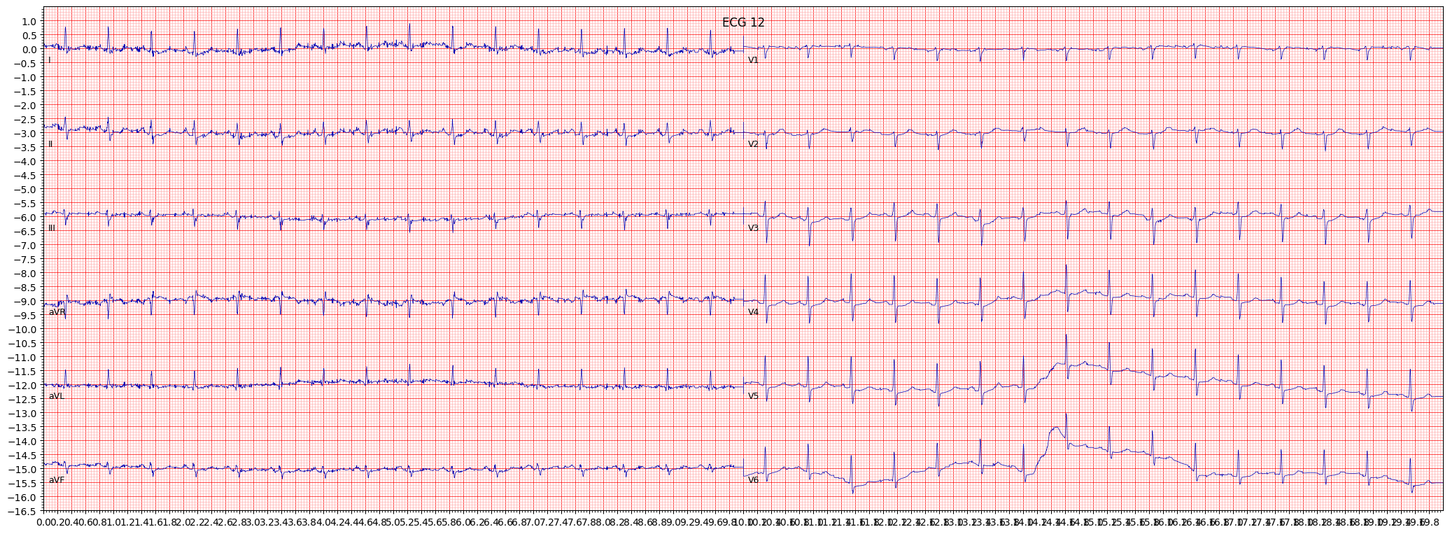 ECG example image