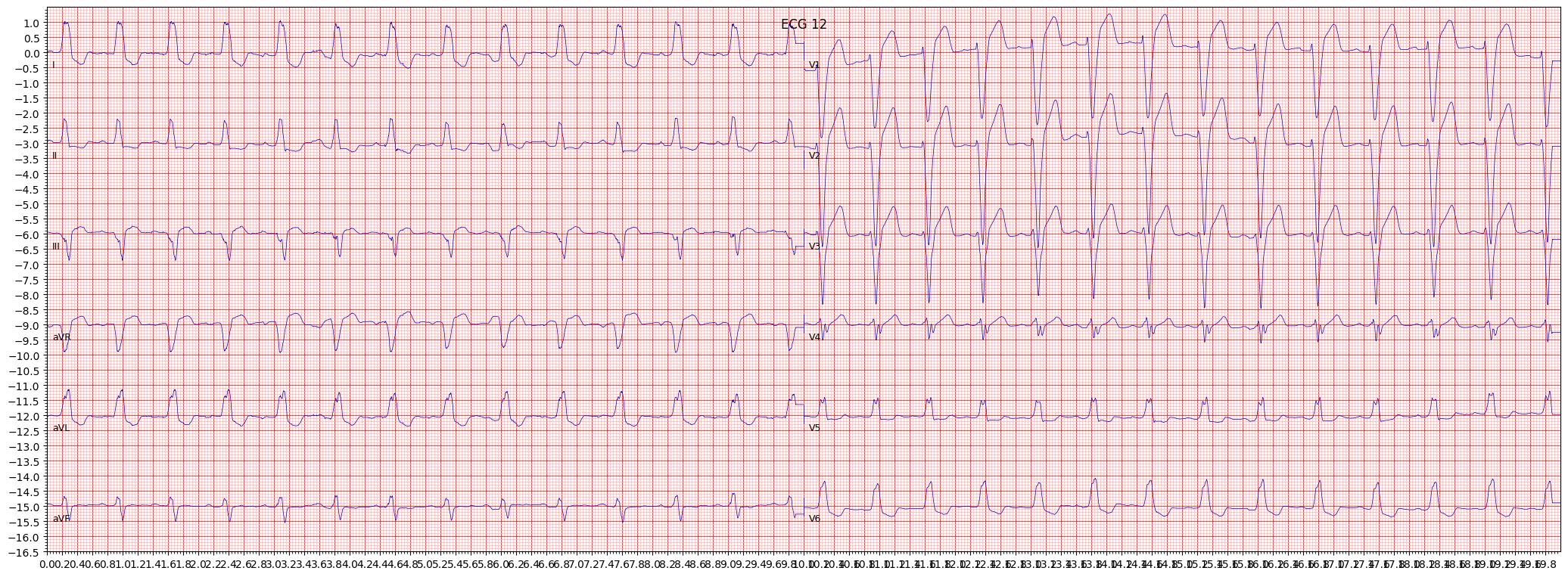 ECG example image