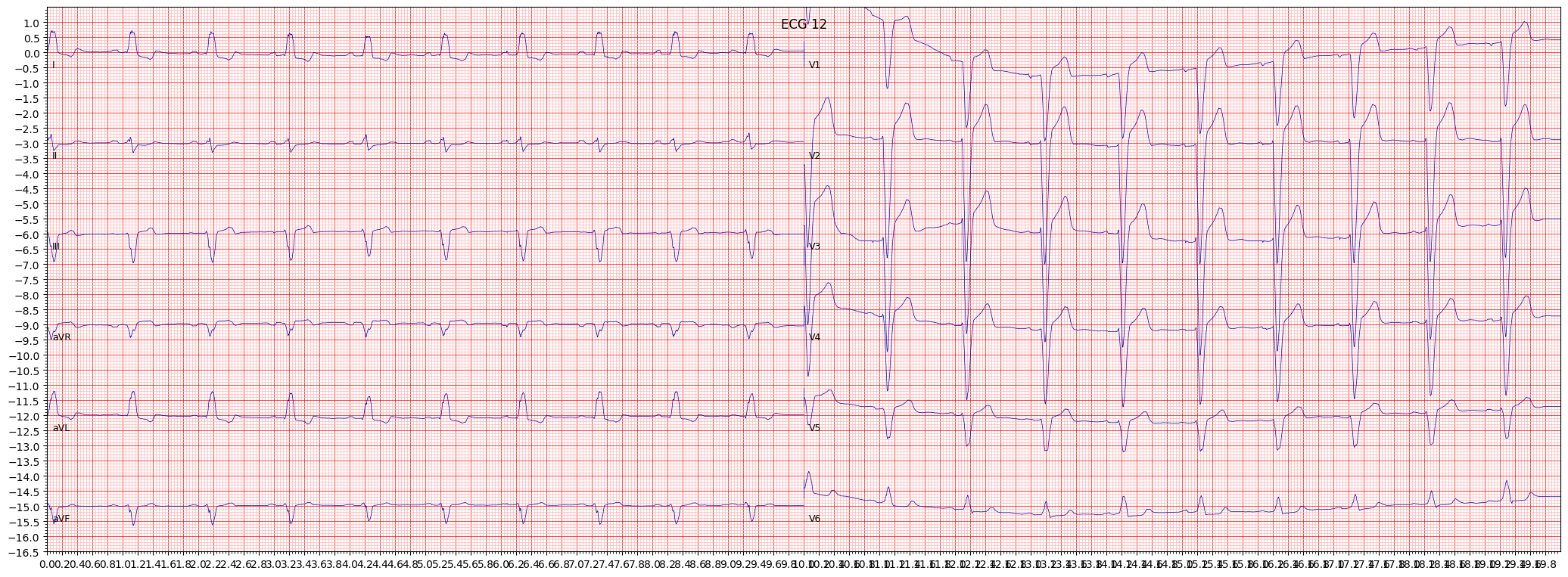 ECG example image