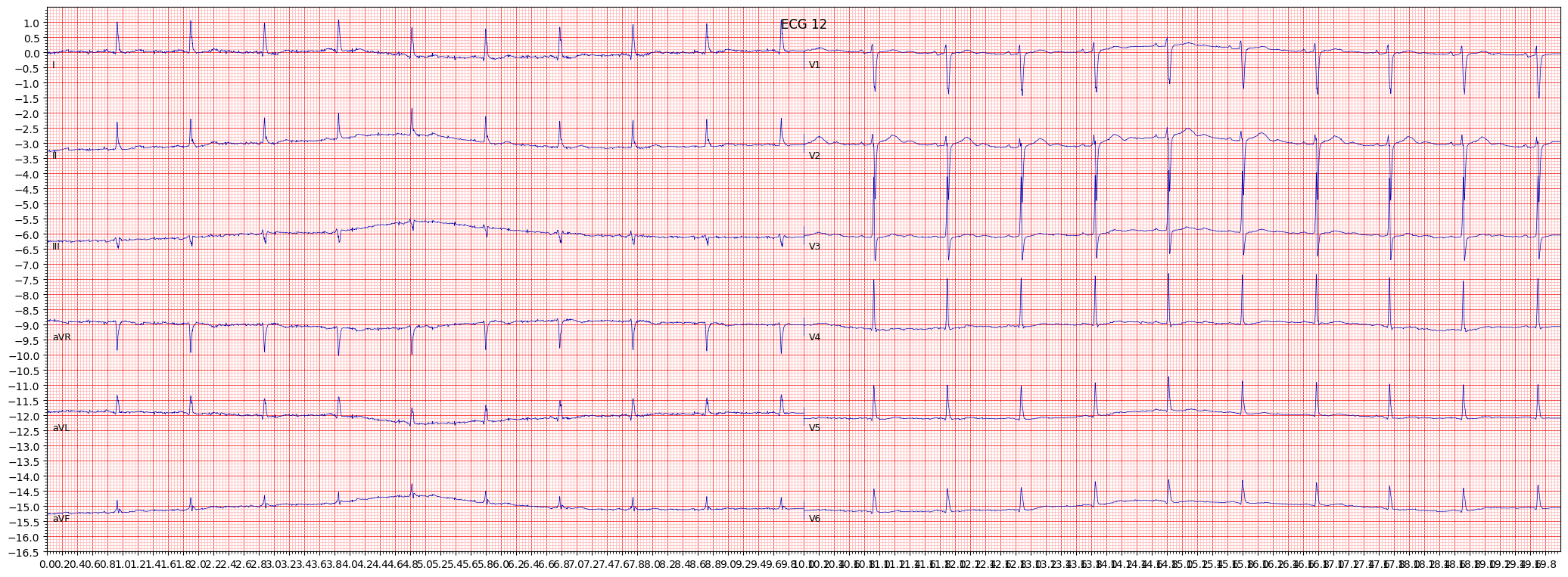 ECG example image