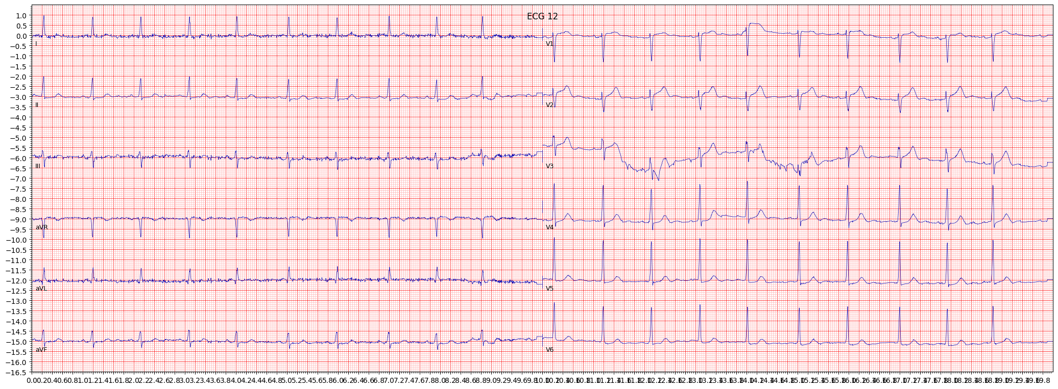 ECG example image