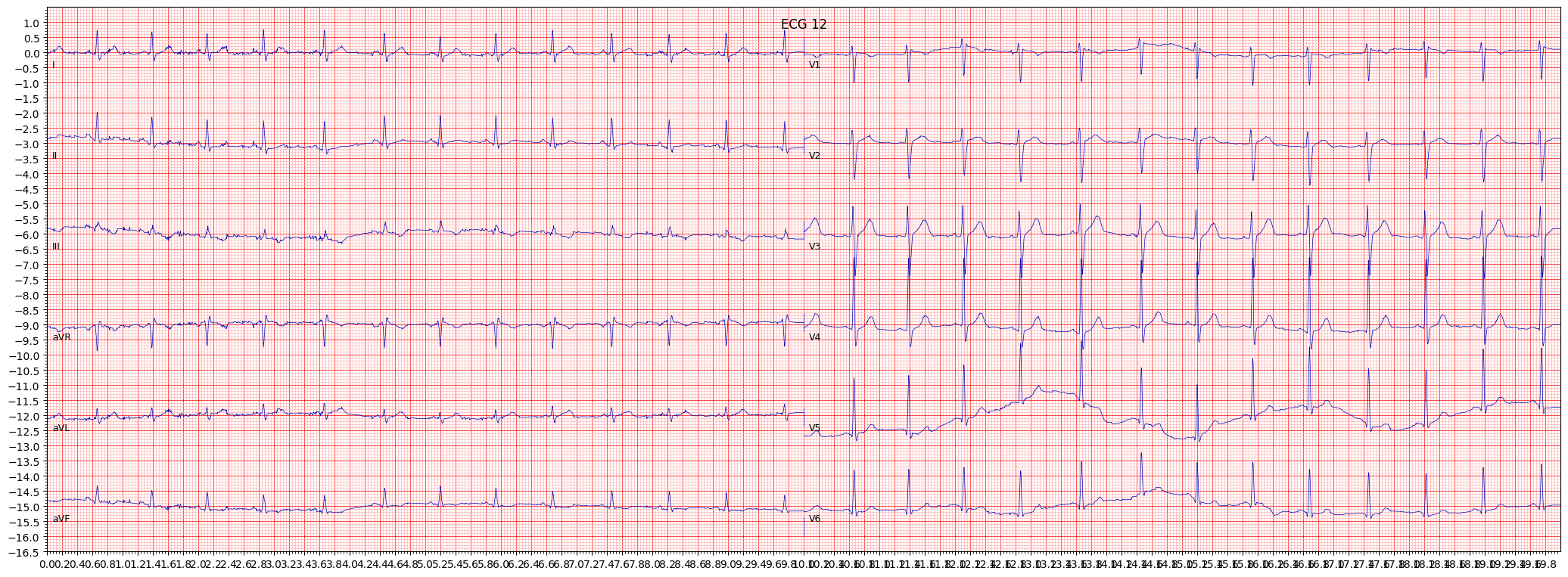 ECG example image