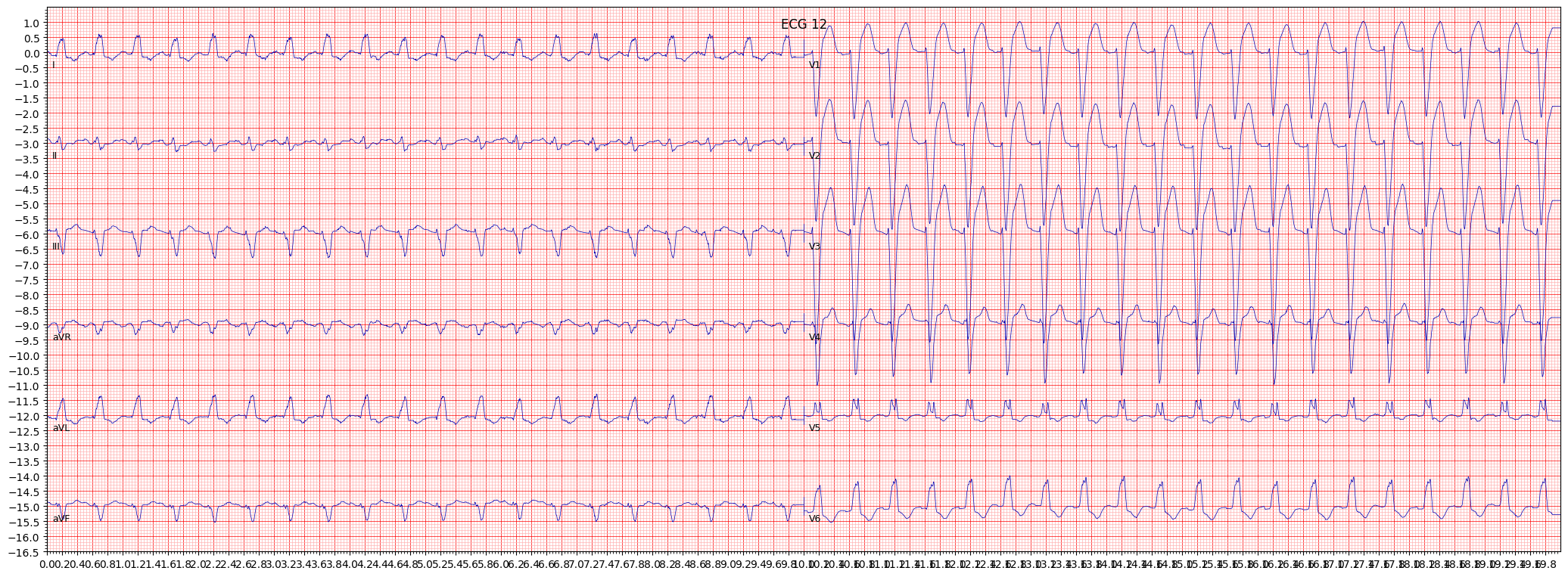 ECG example image