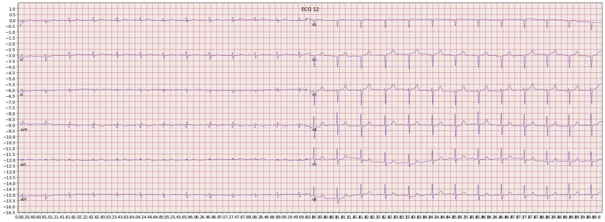 anteroseptal myocardial infarction (ASMI) example 492