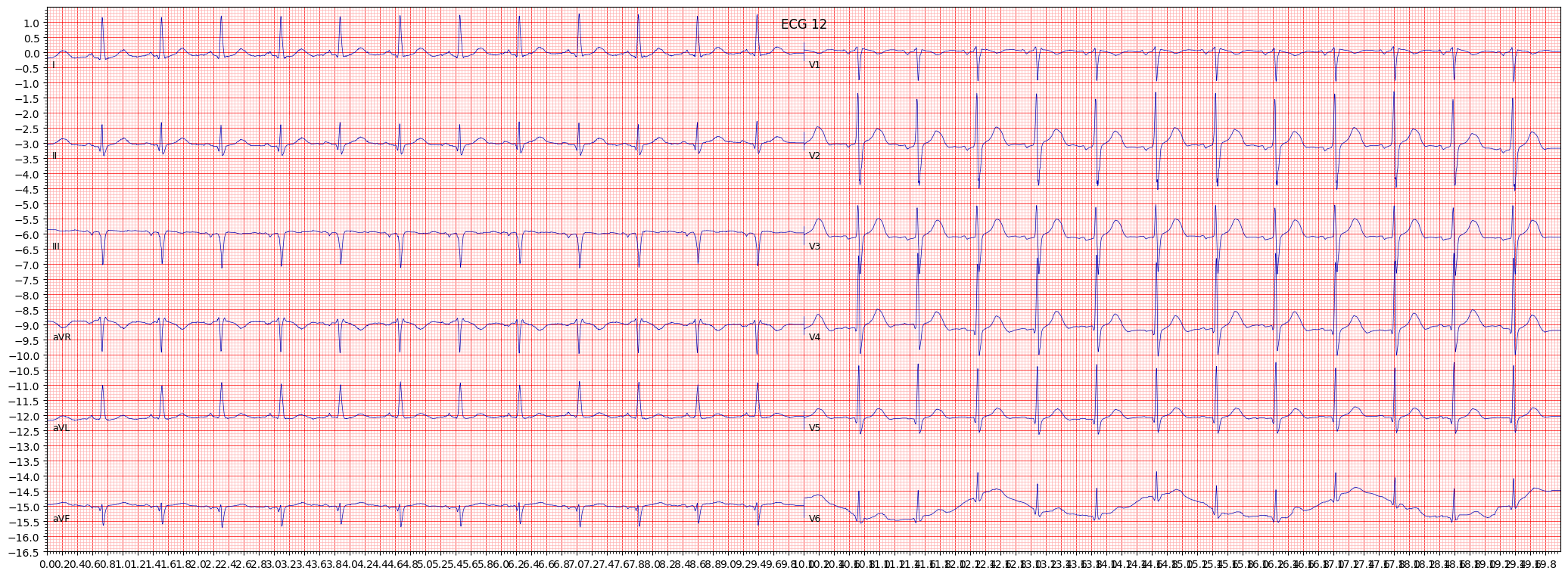 inferolateral myocardial infarction (ILMI) example 4937
