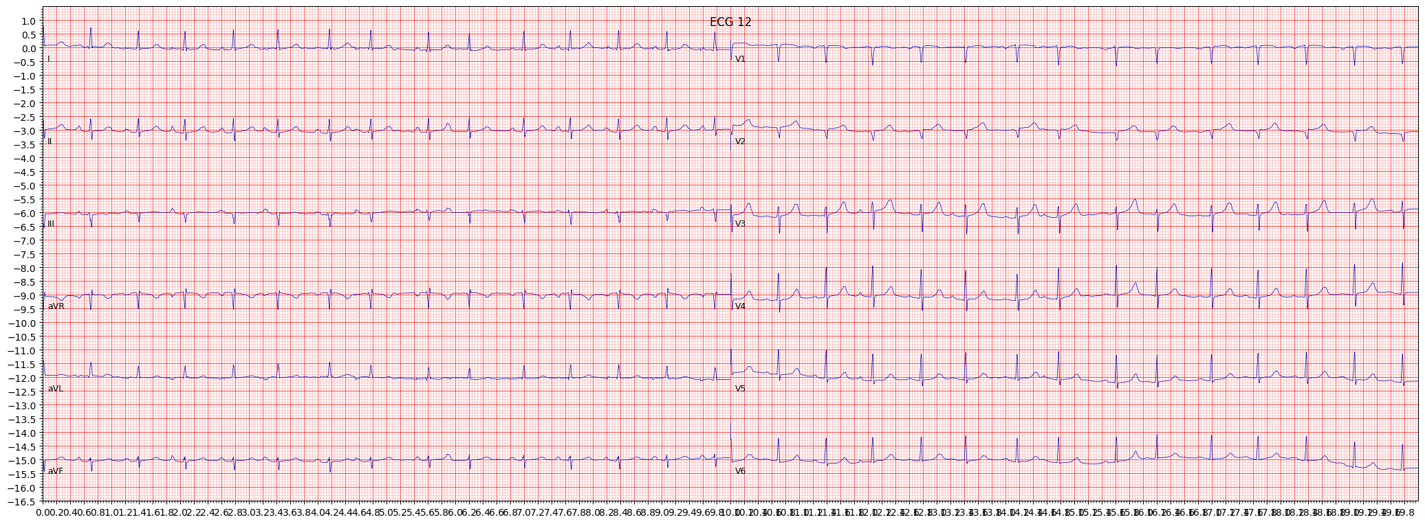 anterior myocardial infarction (AMI) example 4946