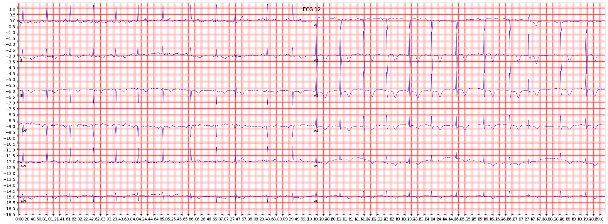 inferoposterolateral myocardial infarction (IPLMI) example 5053