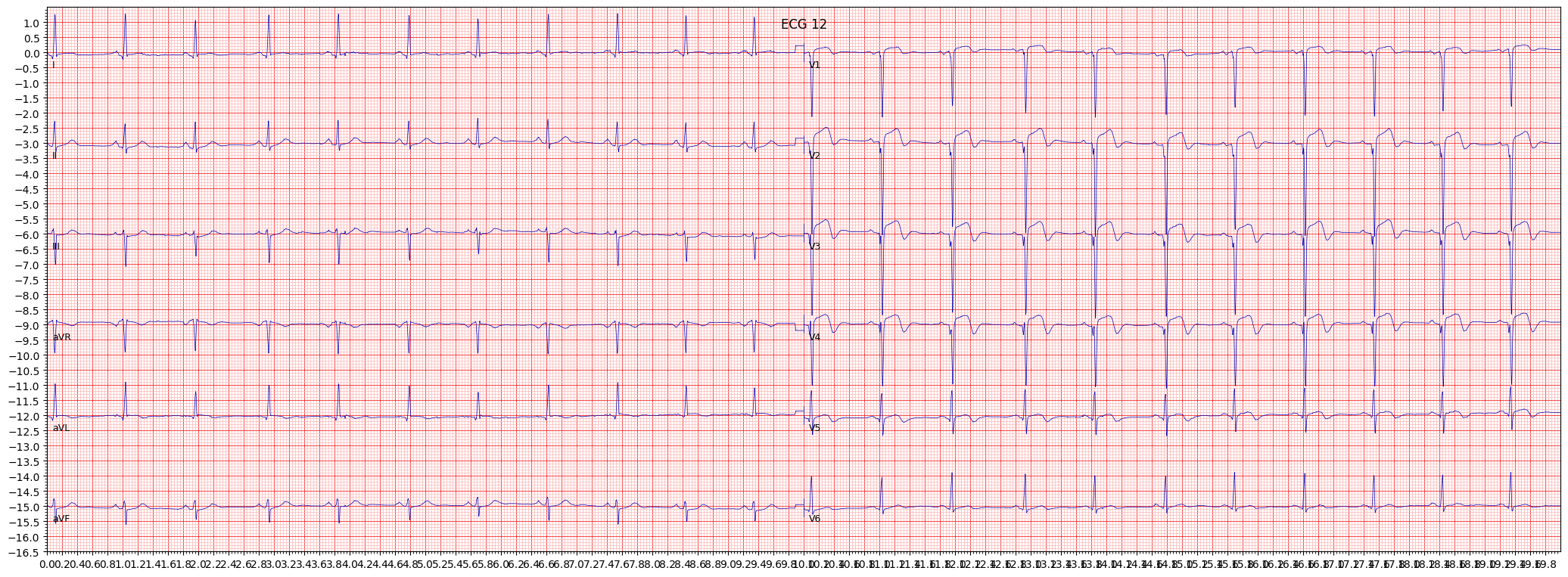 anteroseptal myocardial infarction (ASMI) example 518
