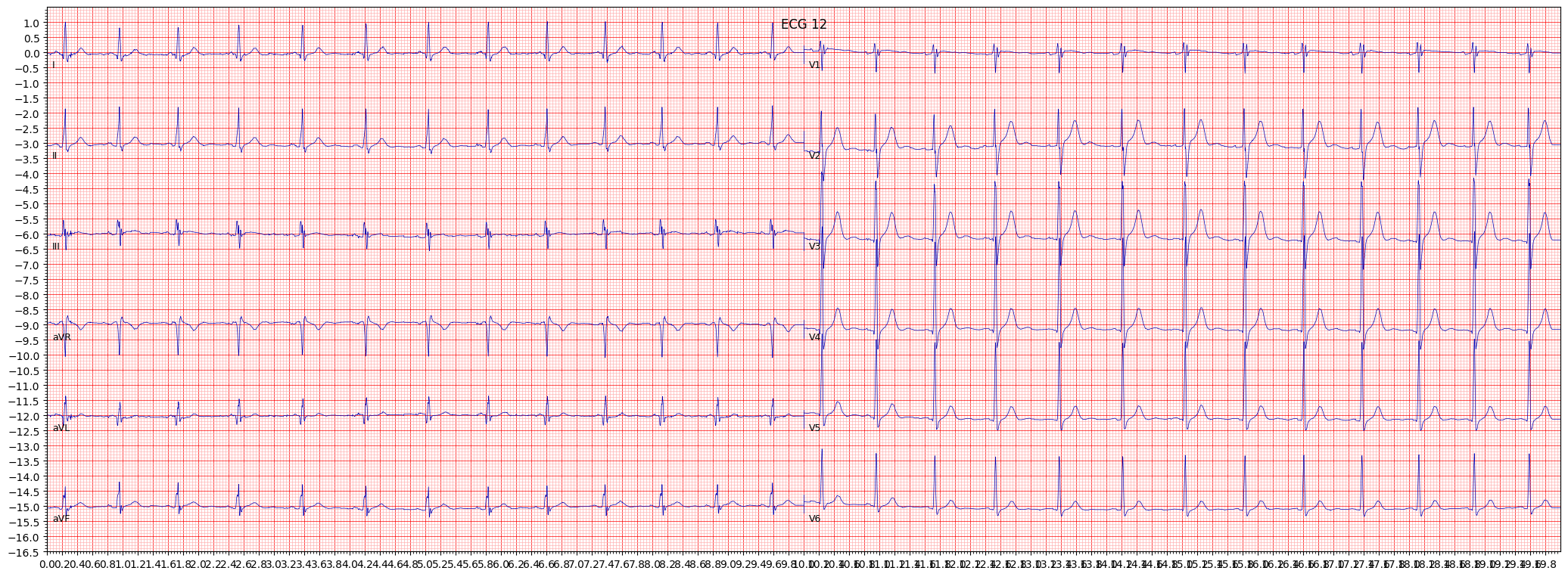 incomplete right bundle branch block (IRBBB) example 52