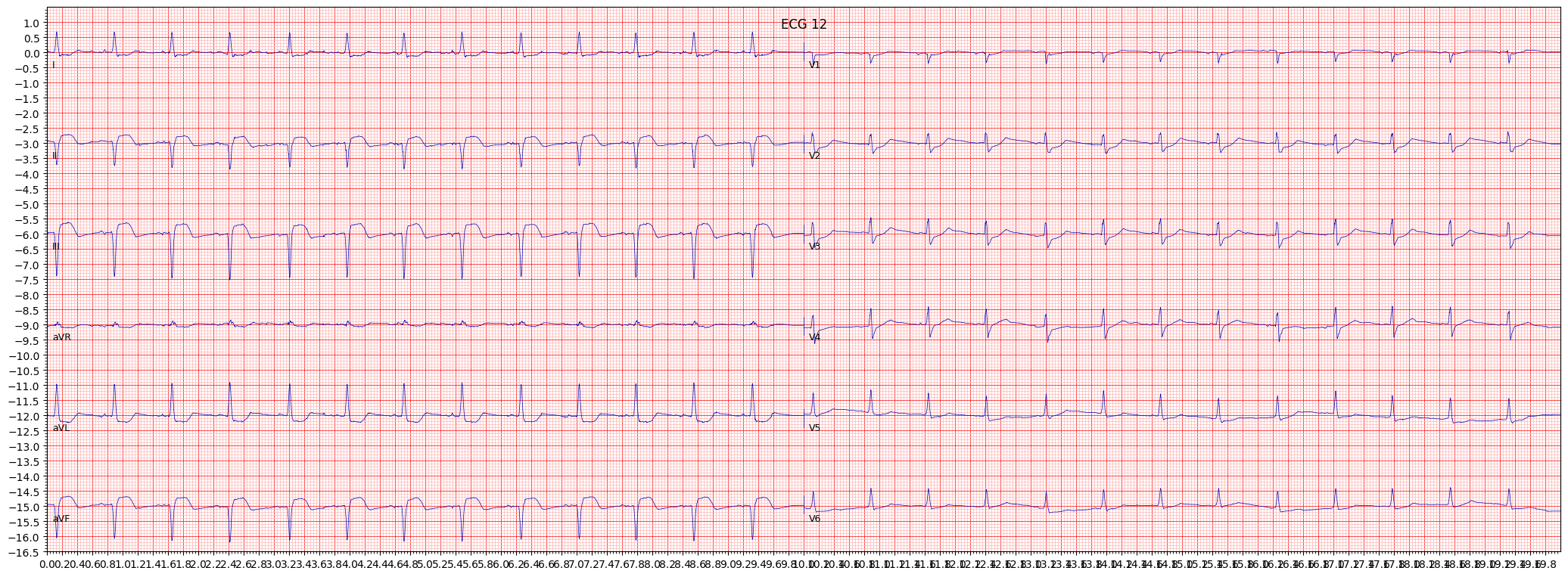inferior myocardial infarction (IMI) example 532