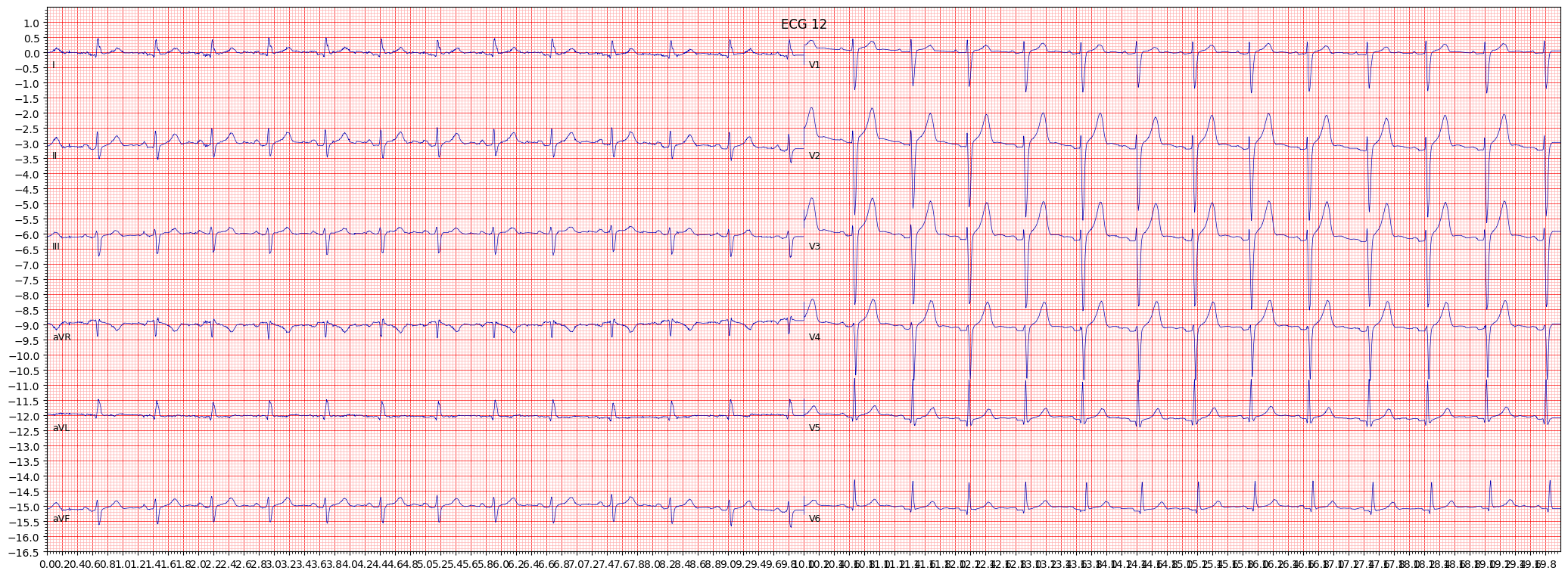 ECG example image