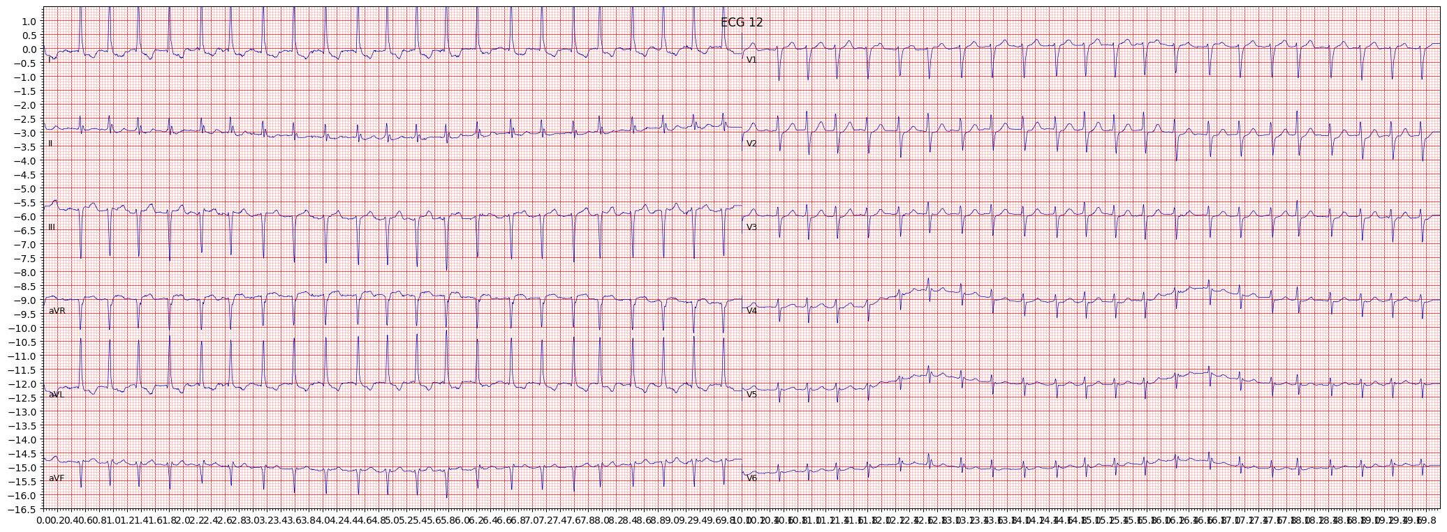 inferior myocardial infarction (IMI) example 567