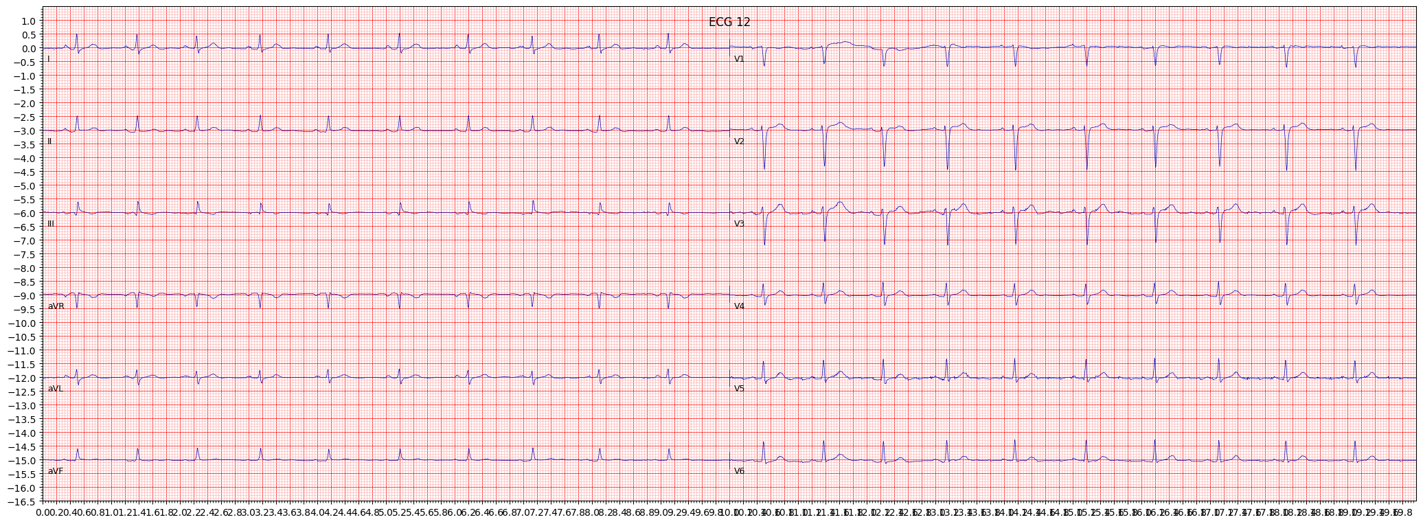 anterior myocardial infarction (AMI) example 5793