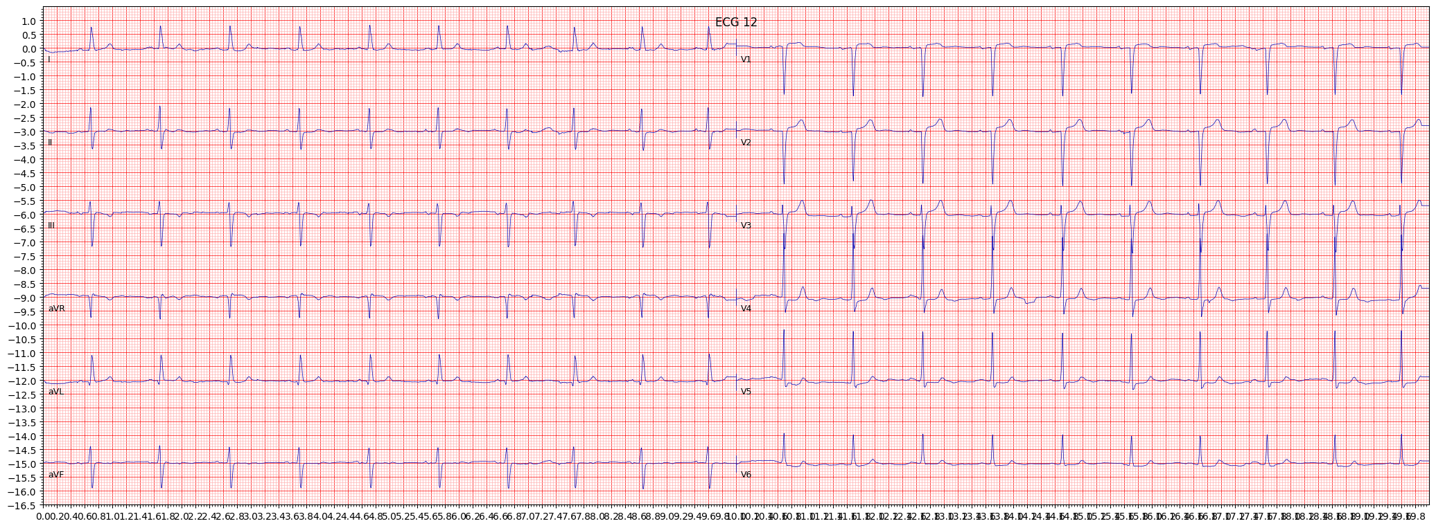anterior myocardial infarction (AMI) example 5862