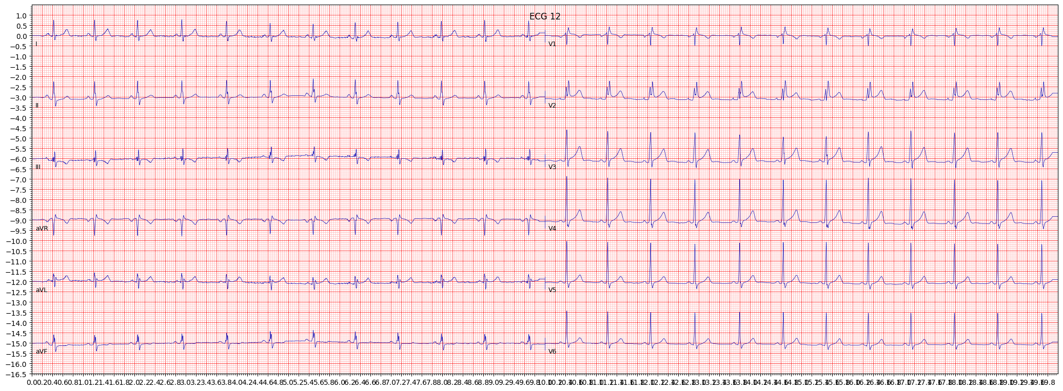 incomplete right bundle branch block (IRBBB) example 588