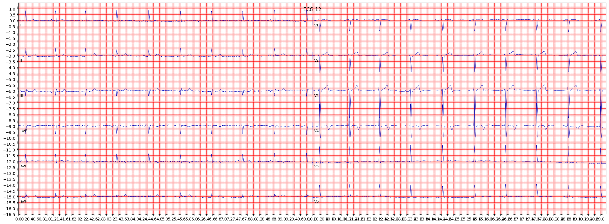subendocardial injury in anteroseptal leads (INJAS) example 6120