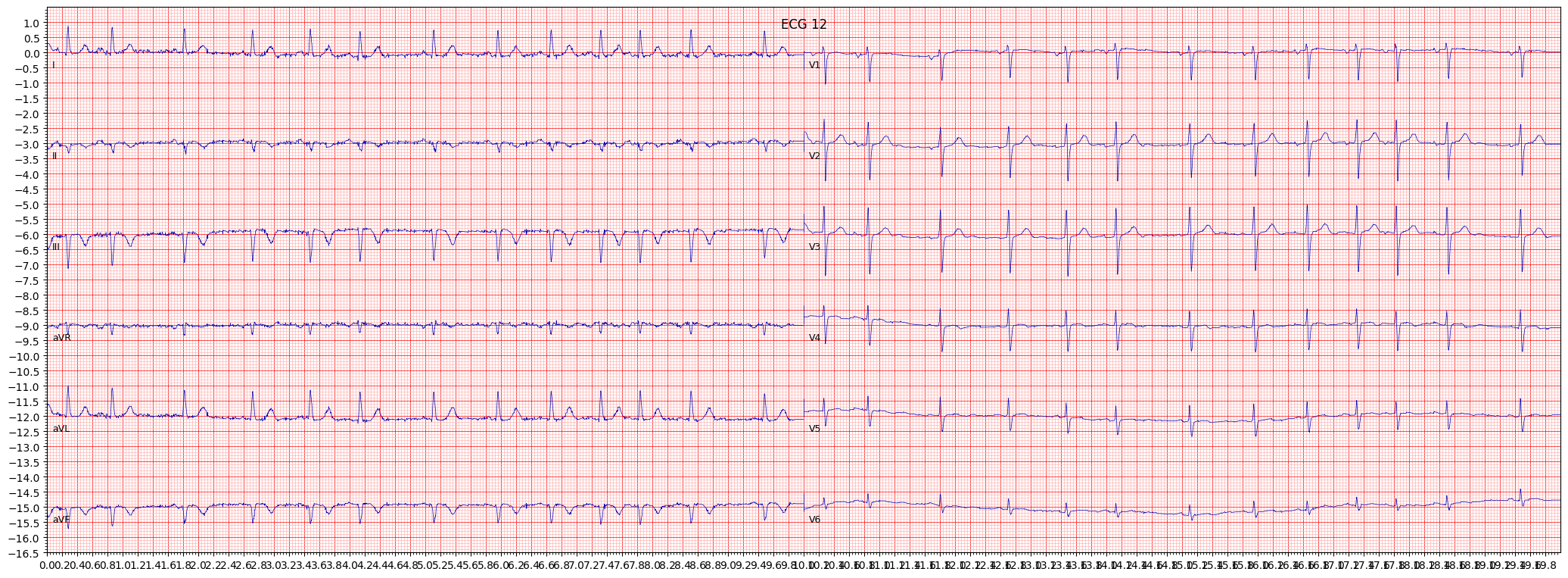 inferolateral myocardial infarction (ILMI) example 6211