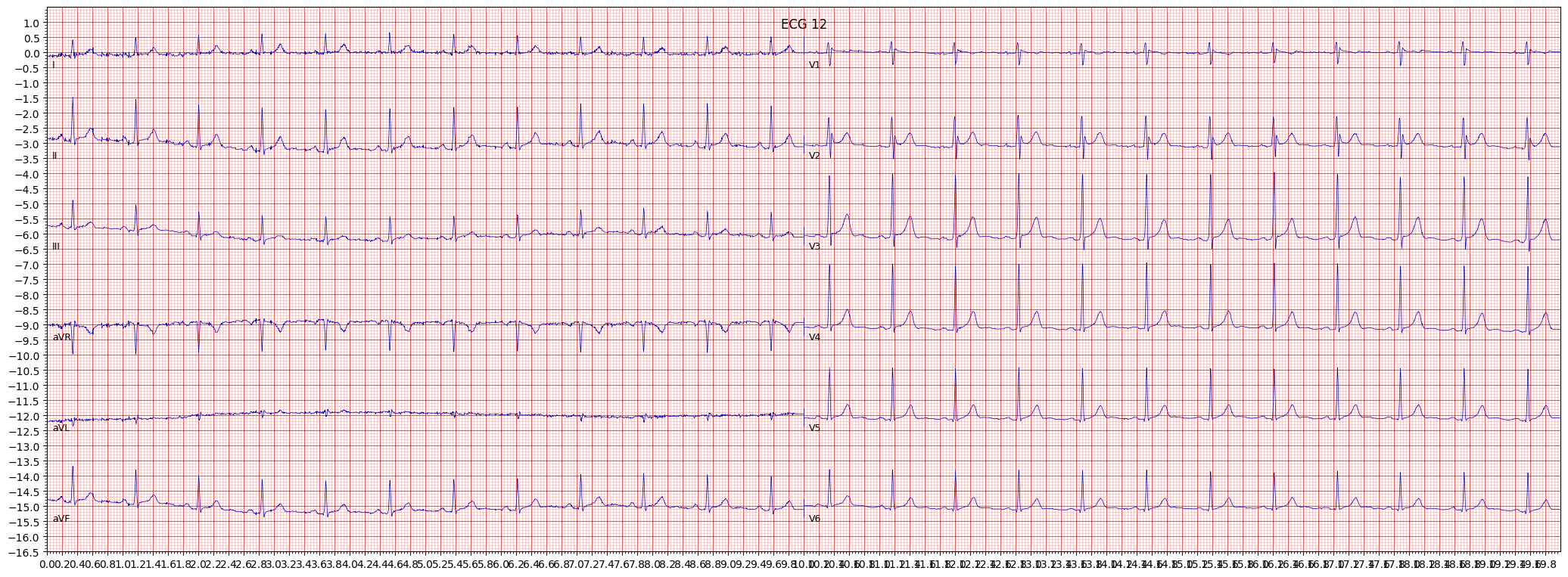 incomplete right bundle branch block (IRBBB) example 65