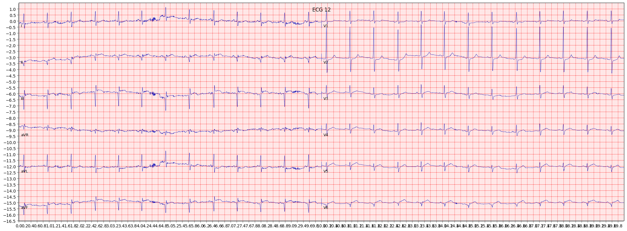 inferoposterolateral myocardial infarction (IPLMI) example 6962