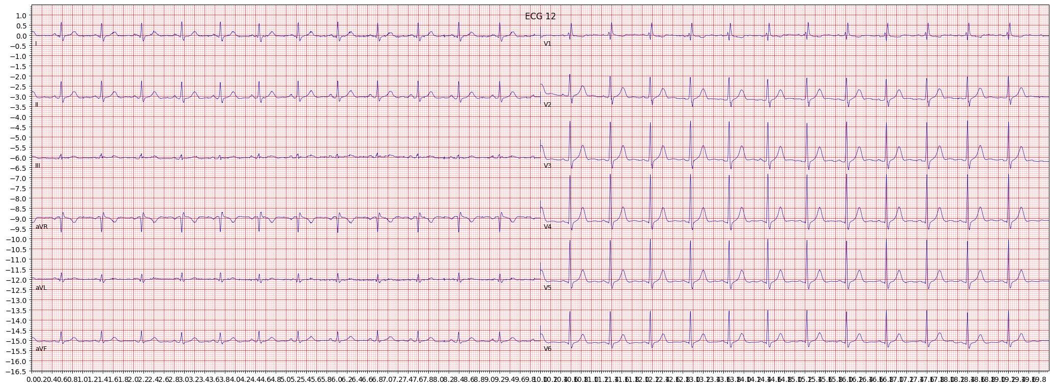 incomplete right bundle branch block (IRBBB) example 724