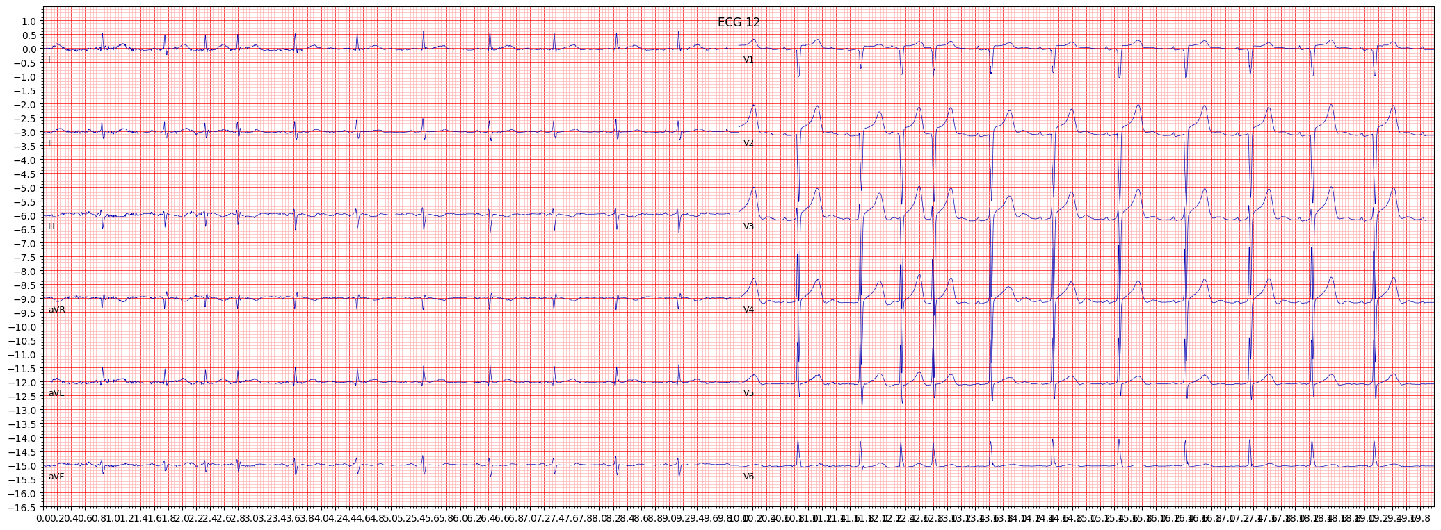 anterior myocardial infarction (AMI) example 7835