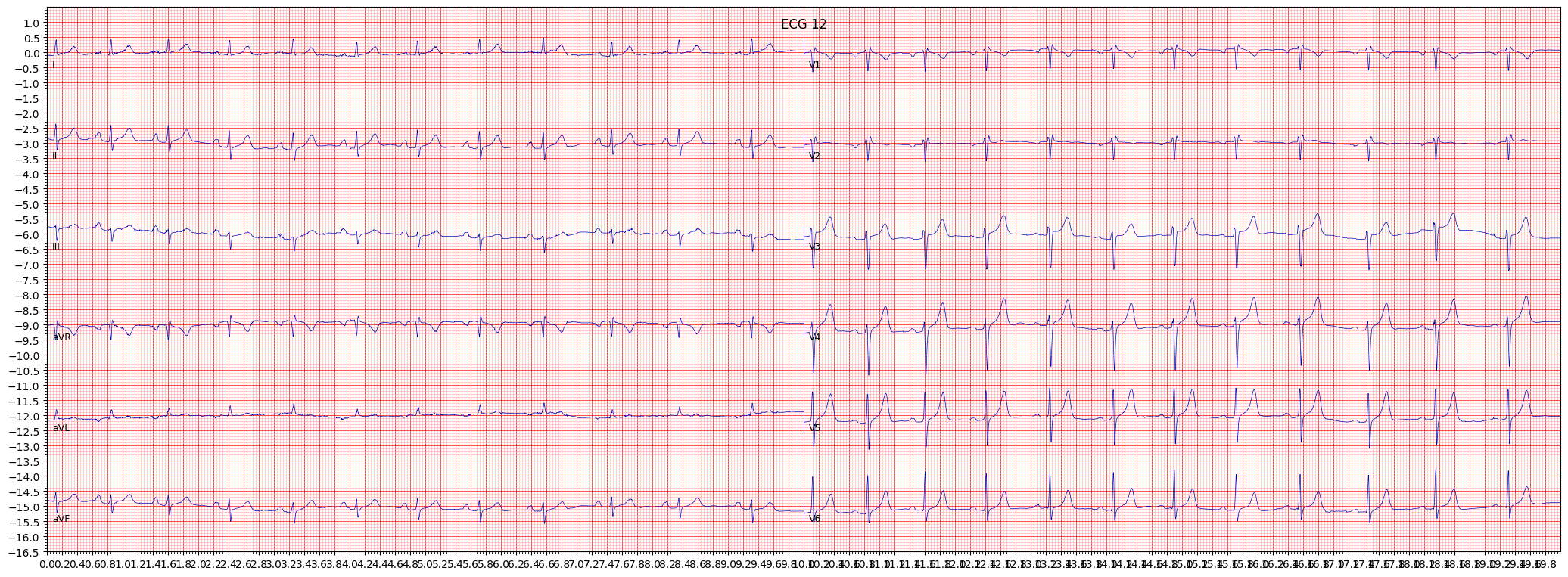incomplete right bundle branch block (IRBBB) example 785