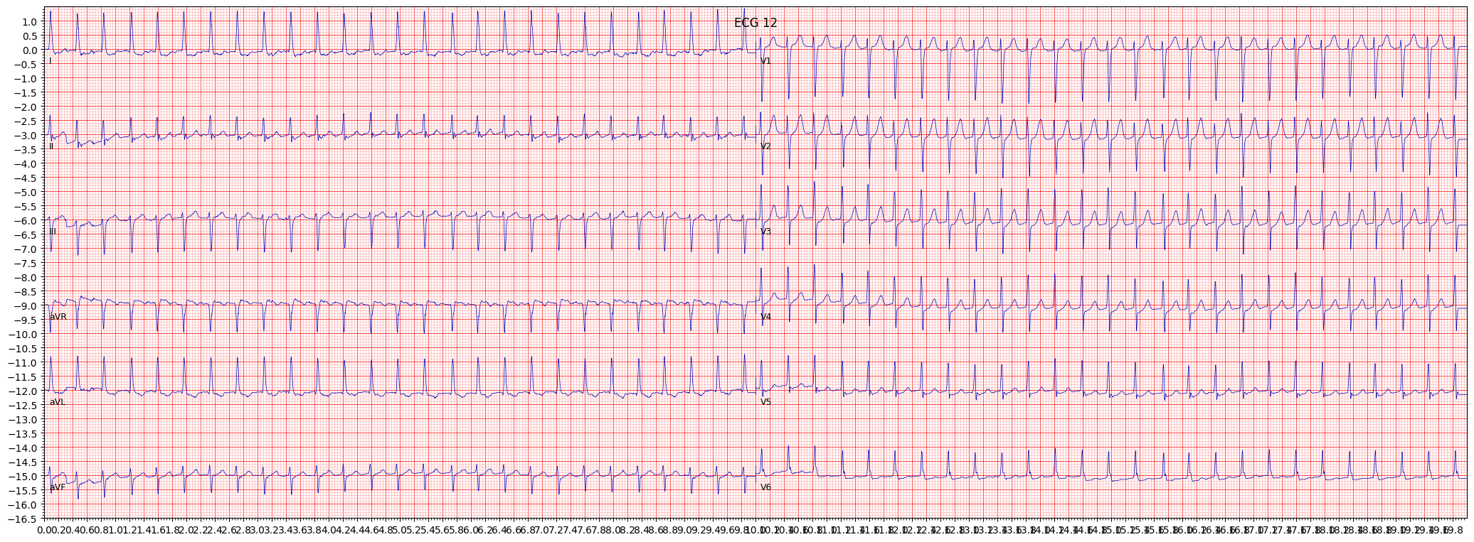 paroxysmal supraventricular tachycardia (PSVT) example 7889
