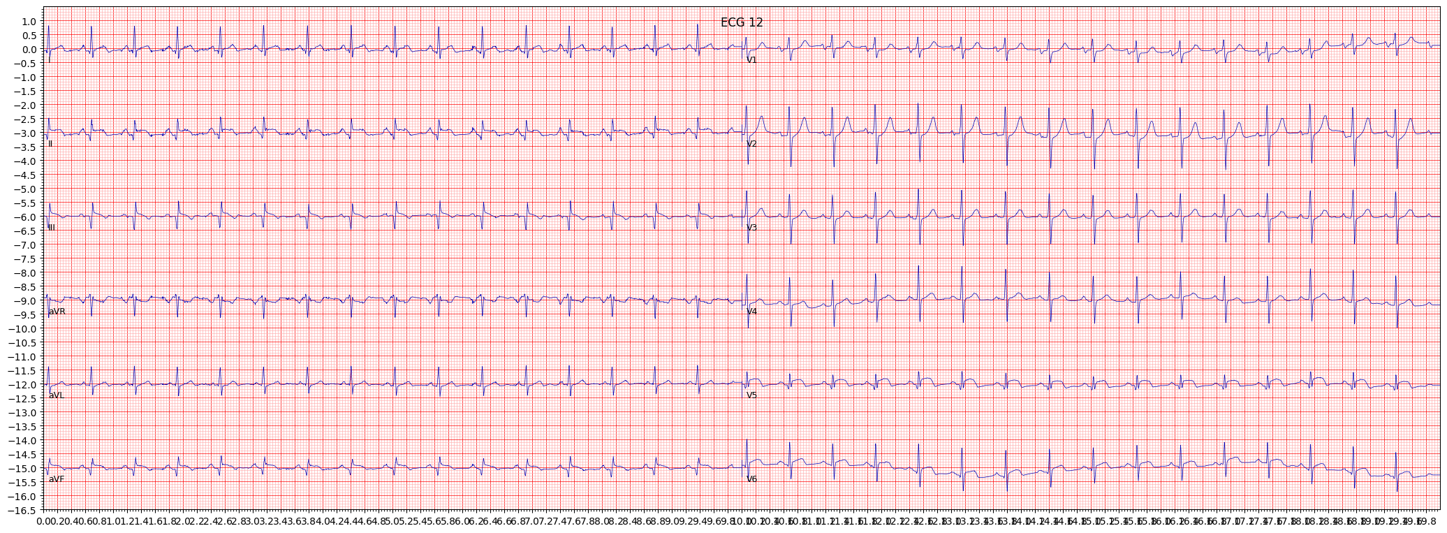 inferolateral myocardial infarction (ILMI) example 827