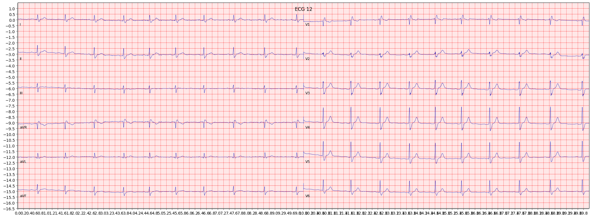 incomplete right bundle branch block (IRBBB) example 836