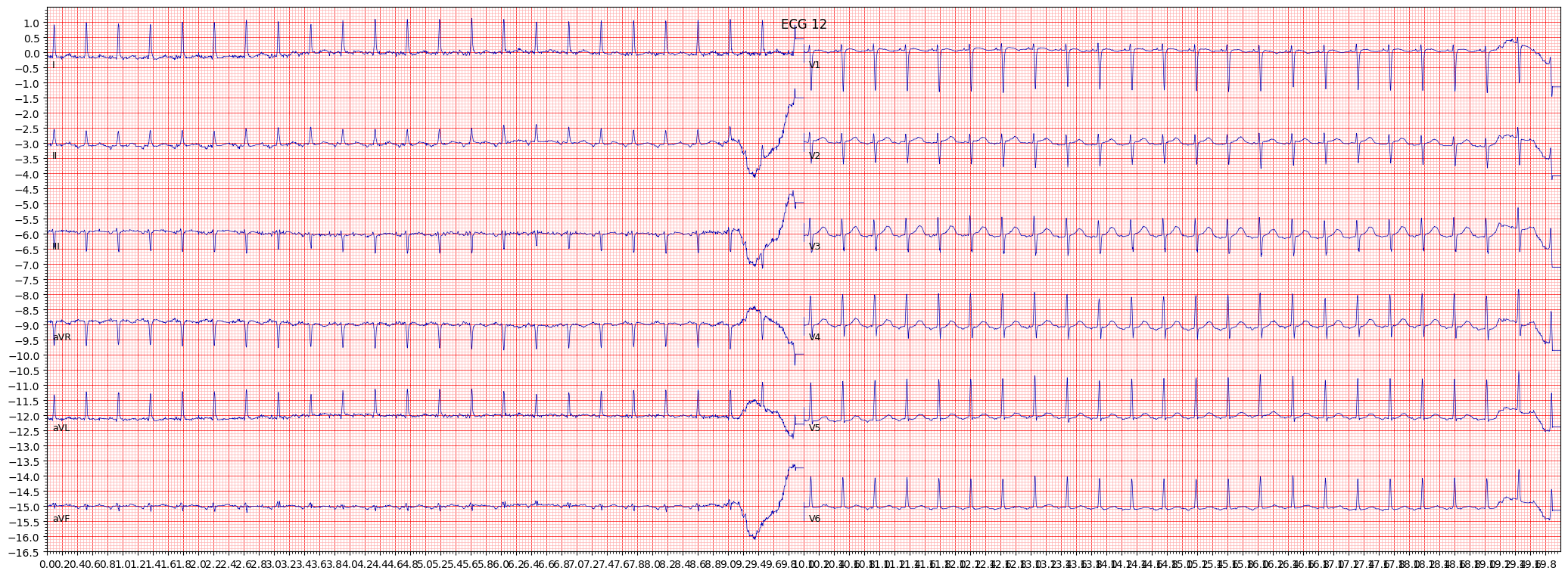paroxysmal supraventricular tachycardia (PSVT) example 8461
