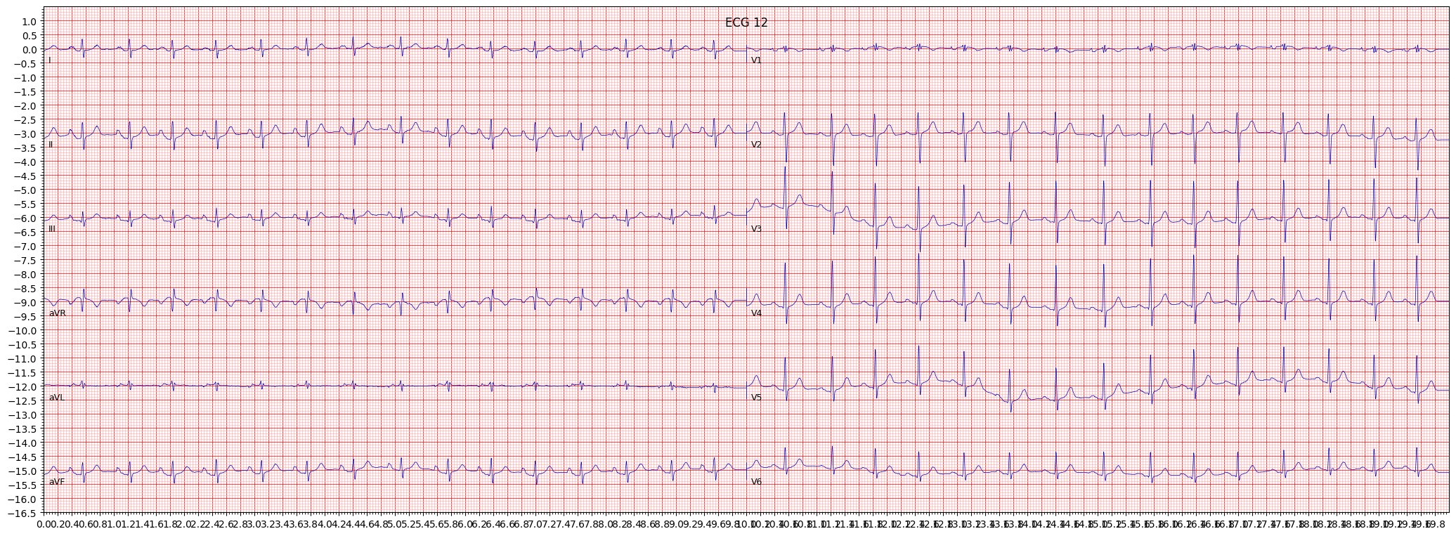 incomplete right bundle branch block (IRBBB) example 938