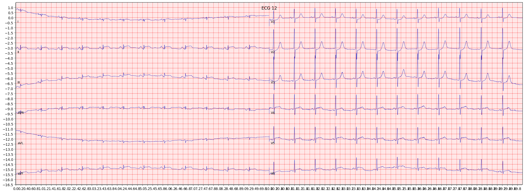 inferolateral myocardial infarction (ILMI) example 947