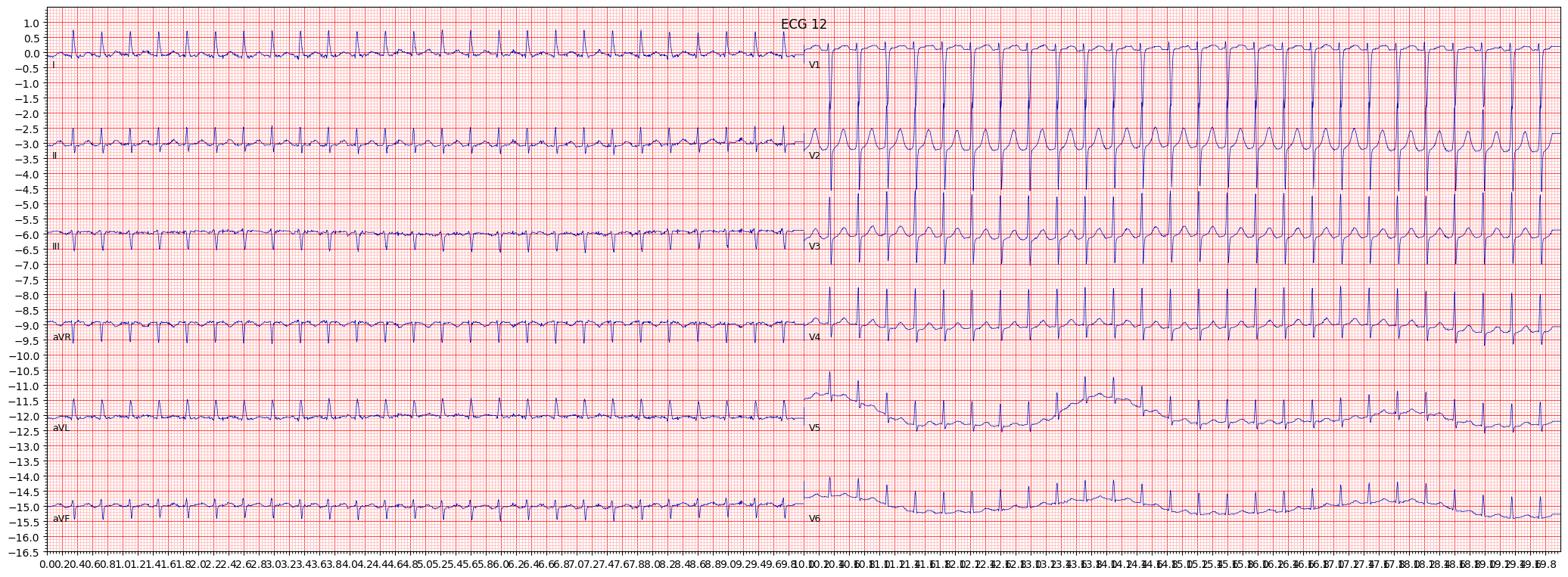 paroxysmal supraventricular tachycardia (PSVT) example 9866